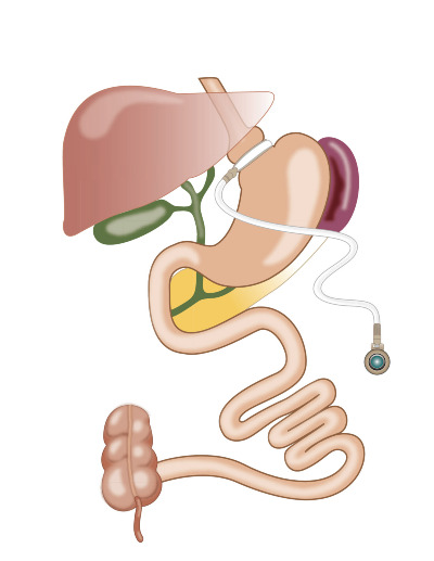 Operative Diagram of Laparoscopic Gastric Banding